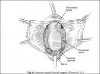 Anterior vaginal fascial support