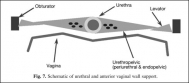 Schematic of urethral and anterior vaginal wall support
