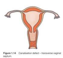 Canalisation defect - transverse vaginal septum