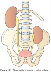 Abnormality of ascent - pelvic kidney